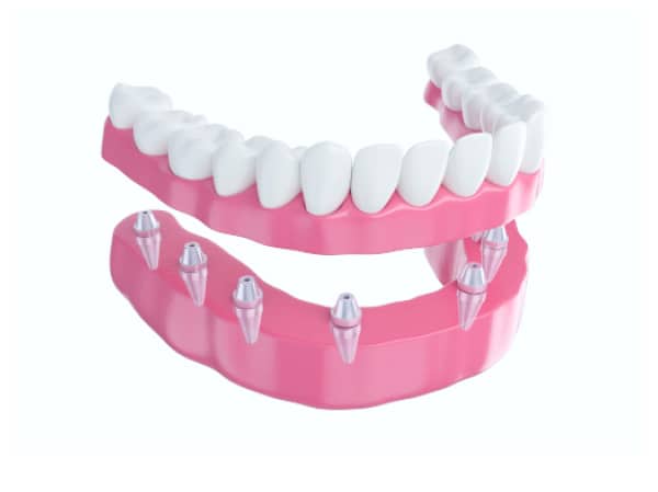 Implant Dentures Austin TX