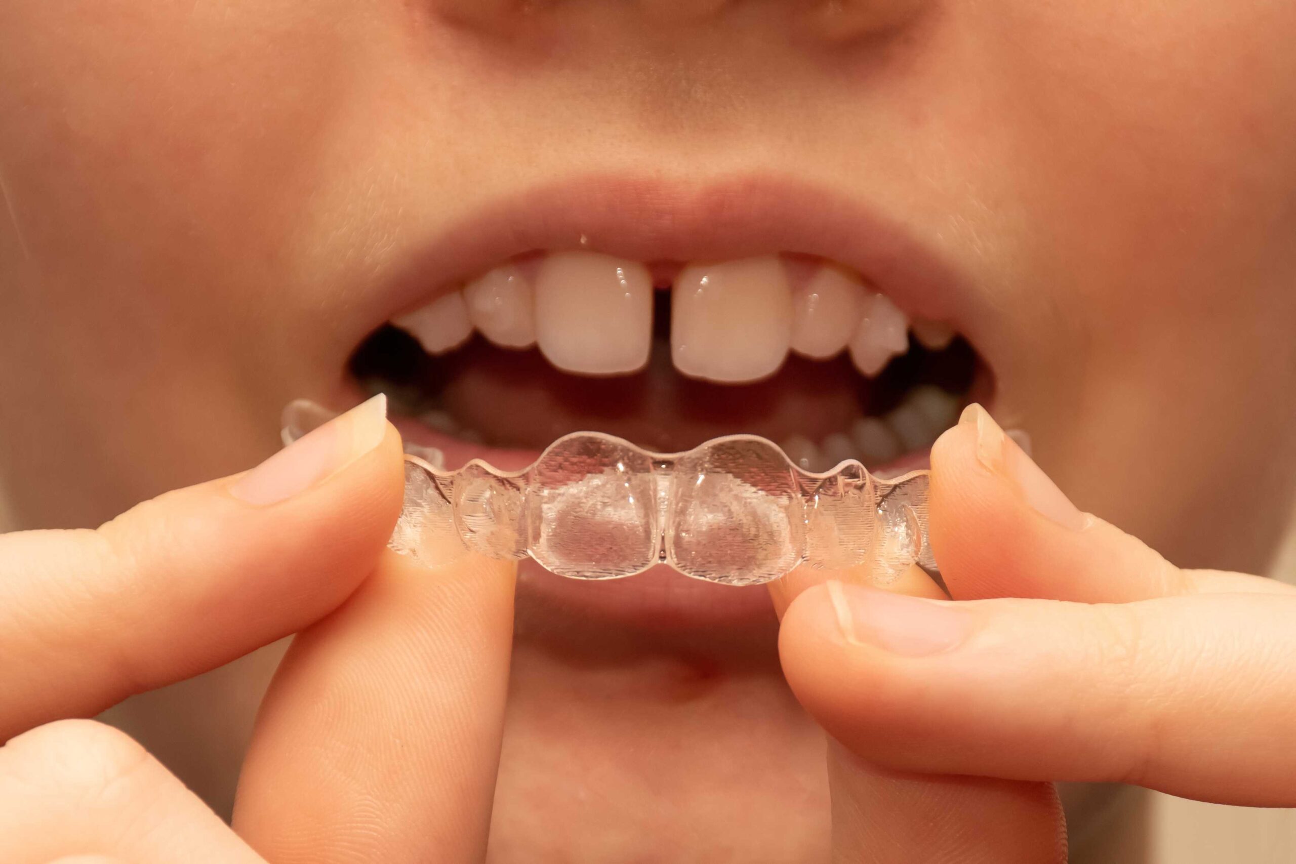 Understanding Invisalign Aligners